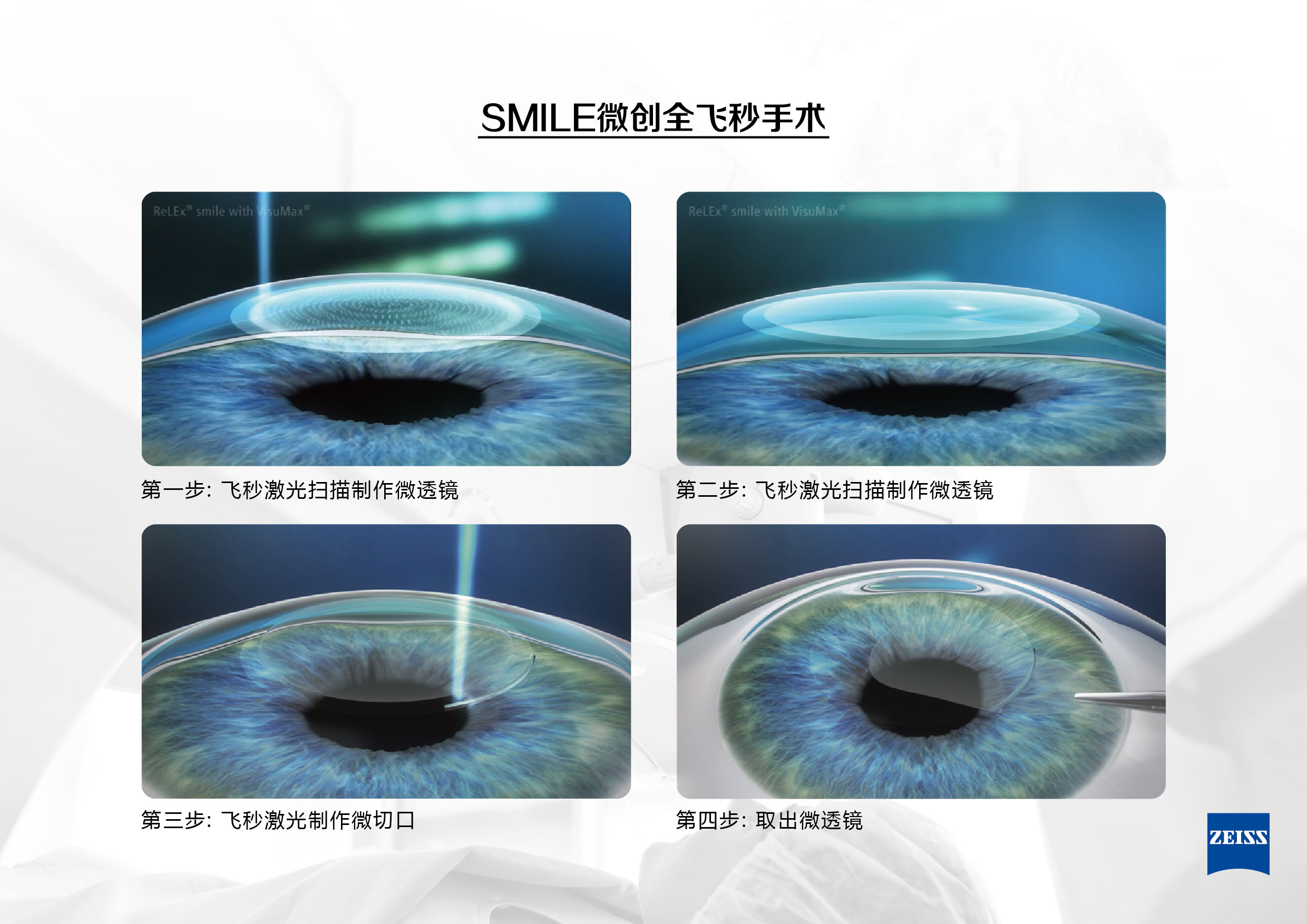 全飛秒SMILE近視手術